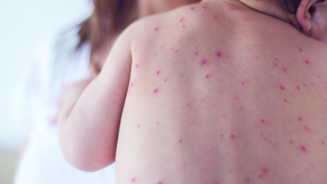 Secondo l'OMS è in atto un'epidemia mondiale di morbillo.