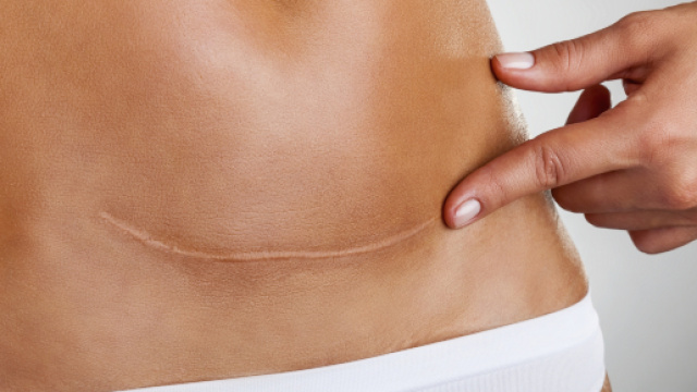 Un accouchement par césarienne, pourquoi et comment ? M comme Maman - mcommemaman.fr