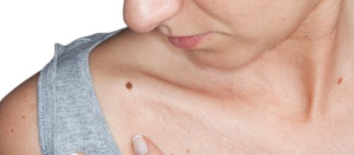 Distinguere un neo da un melanoma: la regola dell'Abcde.