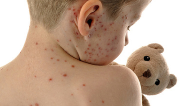 Rimini, epidemia morbillo: arrivate le prime multe ai genitori no-vax