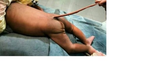 Un niño es operado de “Cola de ratón” en Colombia