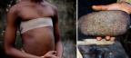 Photogallery - Stiratura del seno: ancora praticata in Africa ma anche nel Regno Unito