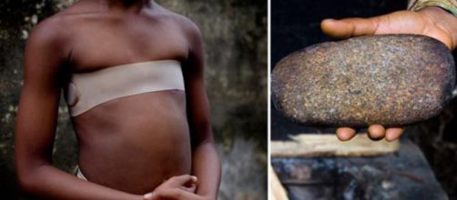 La pratica dello stiramento del seno, attuata principalmente in Camerun, si sta diffondendo anche in UK