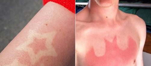 Sunburn tattoos' are the uncool way to show skin this summer HOTnews - hotnews.cx