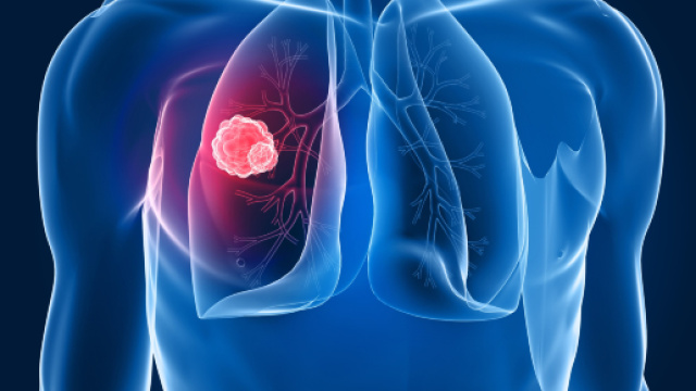 Salute: l'Europa approva il Nivolumab per la cura del tumore al ... - meteoweb.eu