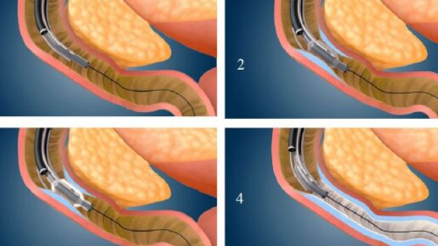 La procedura Fractyl DMR consente di effettuare un’ablazione idrotermica della mucosa duodenale con effetti positivi e permanenti sul diabete.