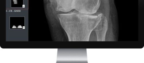 Gleamer a développé BoneView, le premier logiciel qui assiste les radiologues en traumatologie grâce à un diagnostic semi-automatisé, source : DR