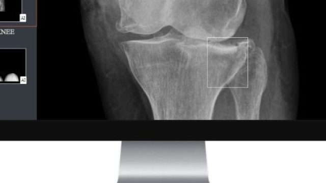 Gleamer a développé BoneView, le premier logiciel qui assiste les radiologues en traumatologie grâce à un diagnostic semi-automatisé, source : DR