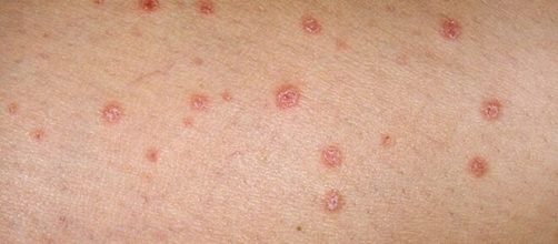 Lesiones cutáneas y picazón podrían ser algunos nuevos síntomas del coronavirus