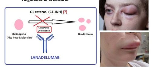 Lanadelumab è un anticorpo, ora disponibile anche in Italia, indicato in una patologia rara, che genera gonfiori sulla pelle e sulle mucose.