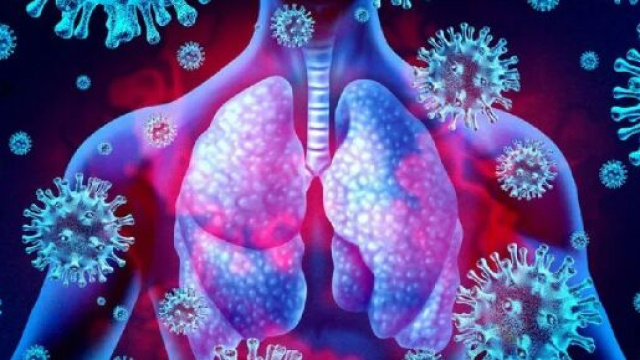 Le polmoniti da nuovo Coronavirus possono generare fibrosi polmonari che compromettono la funzionalit&agrave; polmonare.