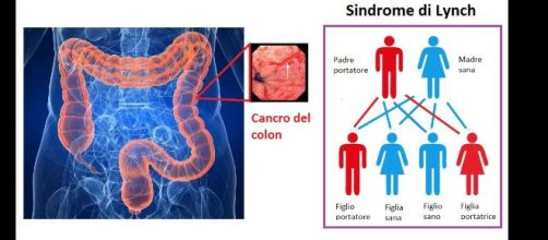 La sindrome di Lynch è una condizione genetica, ereditaria che predispone ad una forma di cancro ereditario del colon-retto, non poliposico.