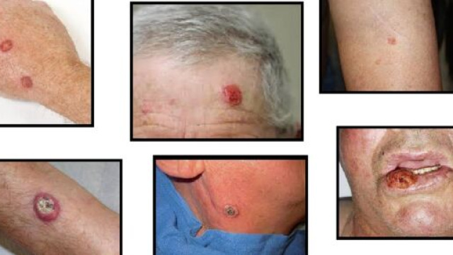 La forma avanzata del carcinoma cutaneo a cellule squamose (CSCC) &egrave; molto rara. Adesso &egrave; disponibile una terapia specifica: Cemiplimab (Libtayo).