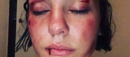 La jeune fille a publié les images de son agression sur les réseaux sociaux, source : capture Twitter - France 3 Occitanie