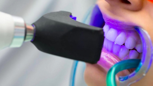 Igiene orale: lo sbiancamento dei denti con il laser.