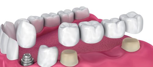 Capsule dentali: quali sono i migliori materiali e come scegliere.