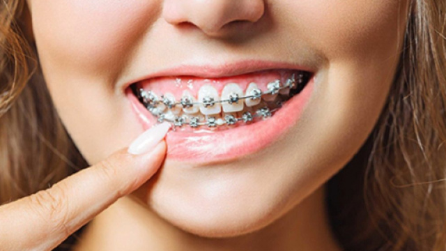 Apparecchi per i denti: scegliere il più adatto tra fissi, mobili e invisibili.