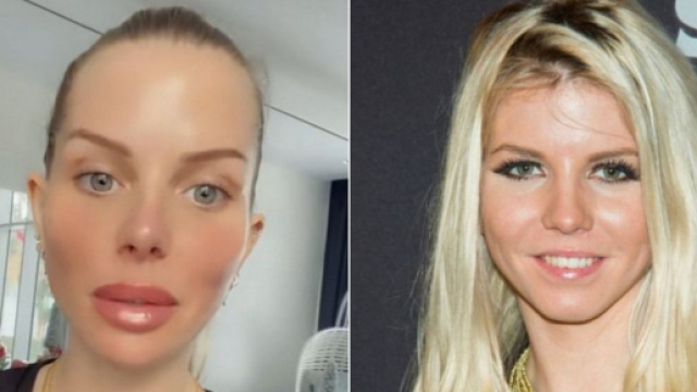 Complexée par ses "lèvres tordues", Jessica Thivenin passe une nouvelle fois par la case chirurgie esthétique.