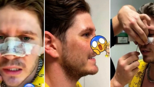 Sebydaddy d&eacute;voile enfin les r&eacute;sultats de sa derni&egrave;re op&eacute;ration de chirurgie esth&eacute;tique. Le ch&eacute;ri de L&eacute;a Mary a refait son nez.