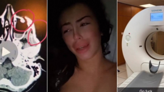 Battue et défigurée par son ex, Dita Istrefi, qui doit se faire opérer en urgence, raconte ce qu'il s'est passé.