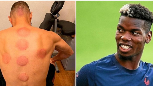 Karim Benzema aurait converti Paul Pogba à la thérapie des ventouses - Source : montage Blasting