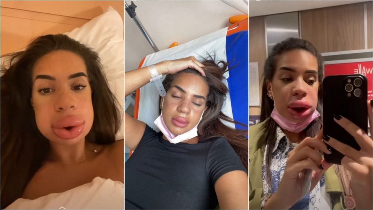 Marwa Les Apprentis Aventuriers Chirurgie Marwa défigurée à cause d'injections, elle part aux urgences et évite le  pire