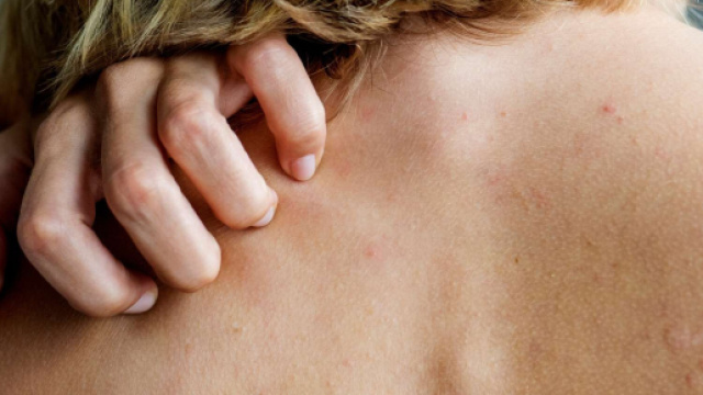 Prurito, pubblicato un nuovo studio.