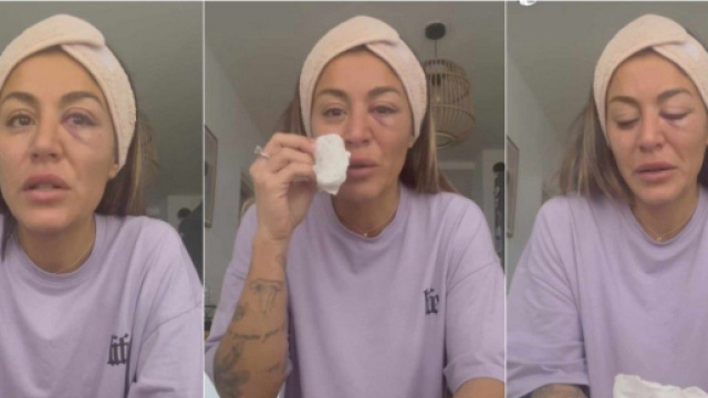 Anaïs Camizuli (Les Cinquante) agressée et frappée au visage par un homme à Marseille, elle raconte tout (Screenshot Instagram@anaiscss7officiel)