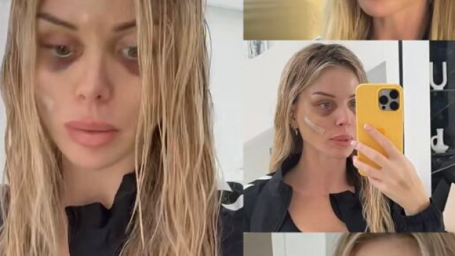Jessica Thivenin après sa dernière opération de lifting. Screenshot story Instagram @jessicathivenin