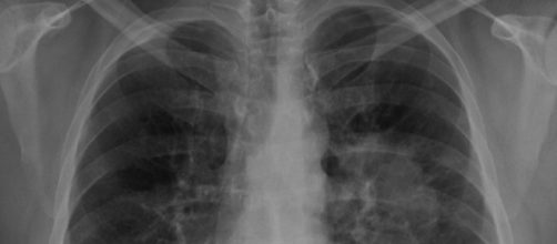 Tres médicos cometieron 'negligencia médica' y provocaron que una mujer se extirpara parcialmente un pulmón (Wikimedia Commons)