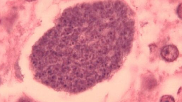 Il parassita responsabile della malaria attacca i globuli rossi © Wikimedia Commons