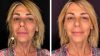 Uomini e donne, ritocchino per Aurora Tropea: iniezioni e botox per migliorare il viso