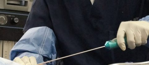 Roma, deceduta a 46 anni dopo liposuzione: indagati medico, anestetista e infermiera