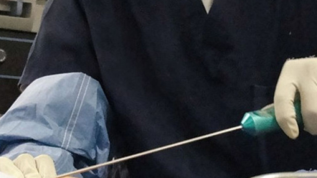 Un intervento di liposuzione © Wikimedia Commons