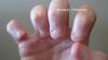 Death by fingernail biting nearly happened to this man