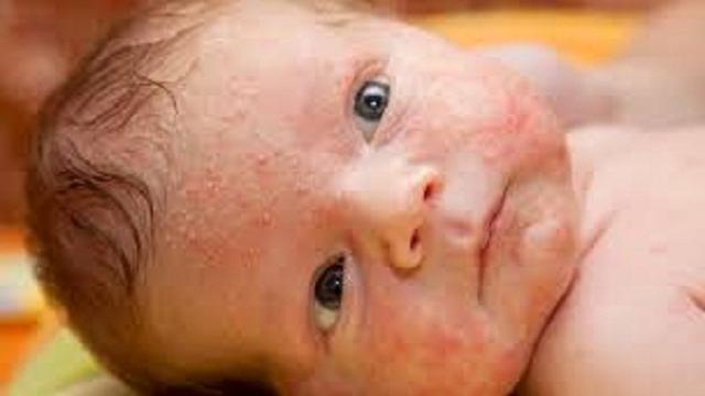VÍDEO: Eritema tóxico del recién nacido…un problema que causa desvelos