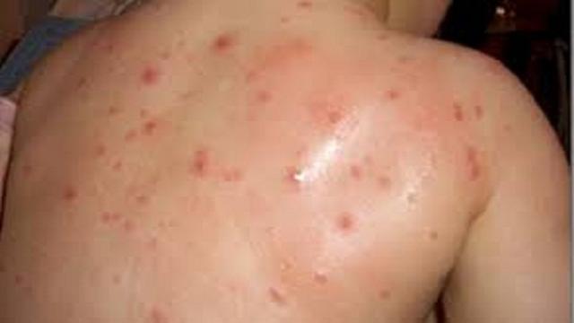 VIDEO: Virus herpes varicela zóster