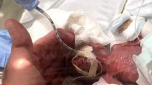 Bebê que nasceu pesando 238 gramas em Tóquio recebe alta