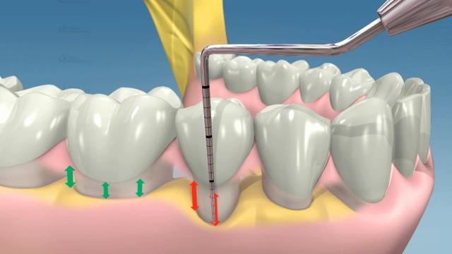 Il batterio Porphyromonas gingivalis è tra i più pericolosi per la salute della bocca