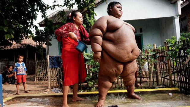 Criança perde 109 kg e deixa de ser o menino mais gordo do mundo