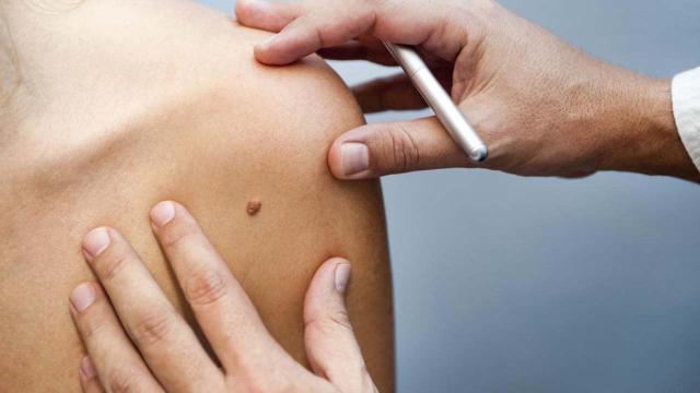 Nei e melanoma: la regola 'Abcde' per distinguerli