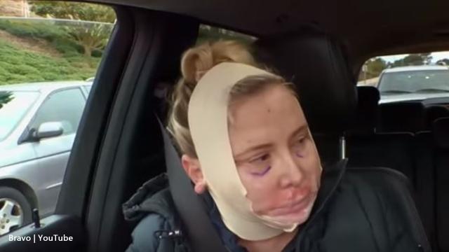 'RHOC': Shannon Beador's plastic surgery looked very sore in the trailer
