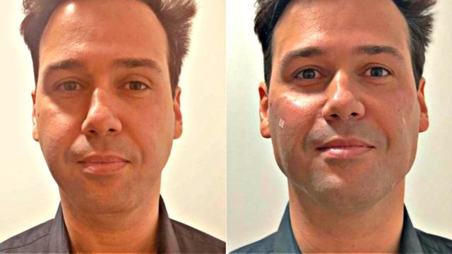 Famosos antes e depois da harmonização facial e valor do procedimento