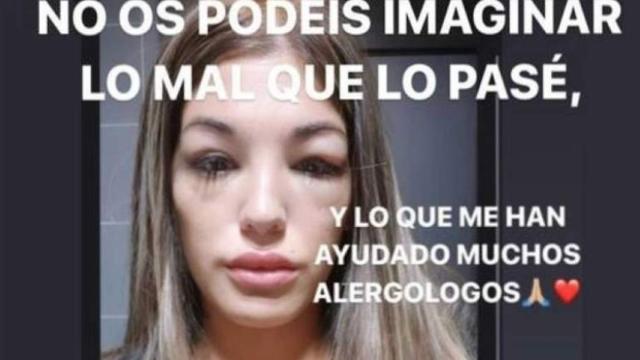 Nuria Martínez, ex concursante de 'GH VIP', muestra cómo quedó su cara por la alergia